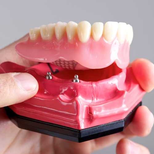 Flexible Partial Dentures Gooding ID 83330